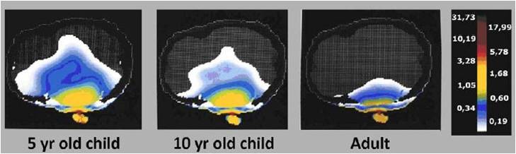 RF stråling oppvarming av vev i hodet