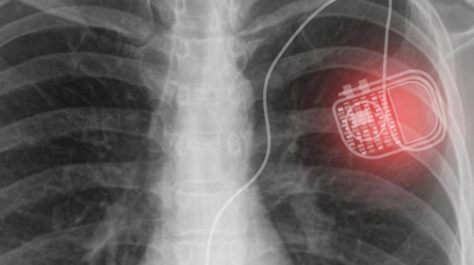 EMF og pacemaker